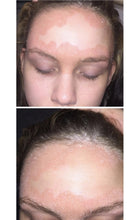 Load image into Gallery viewer, *NEW* Plant Based Steroid Free Sensitive Skin &amp; Scalp Solution (Angry,flakey,steroid withdrawal prone, irritated skin of all ages)